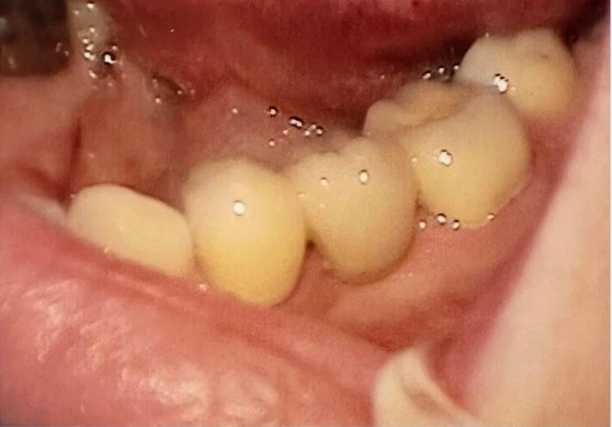Bridge case after dental treatment