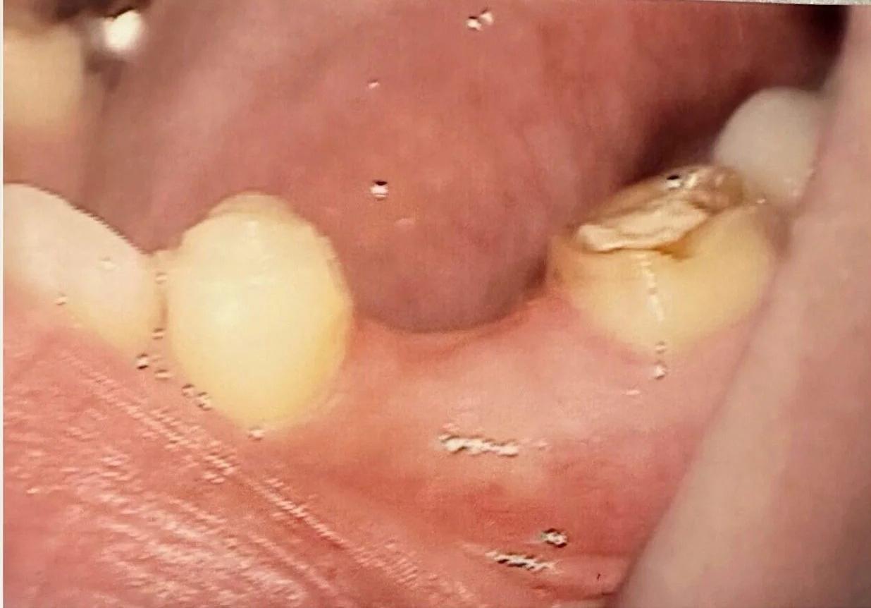 Bridge case before dental treatment
