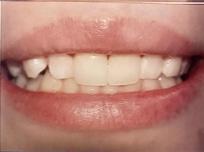 Smile makeover after dental treatment