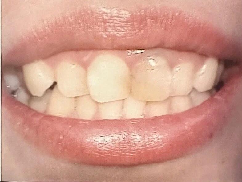 Smile makeover before dental treatment
