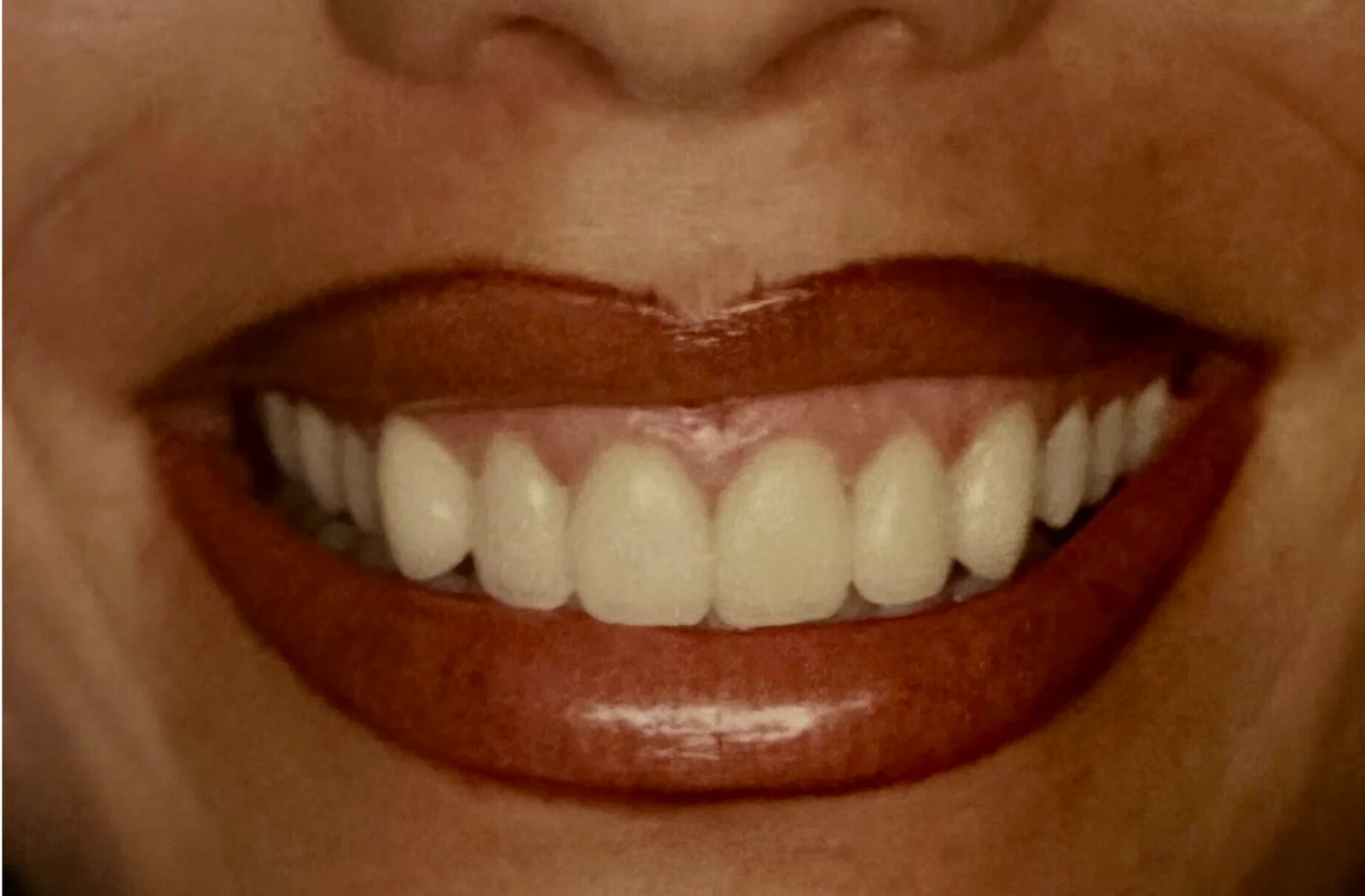 Second smile makeover after dental treatment