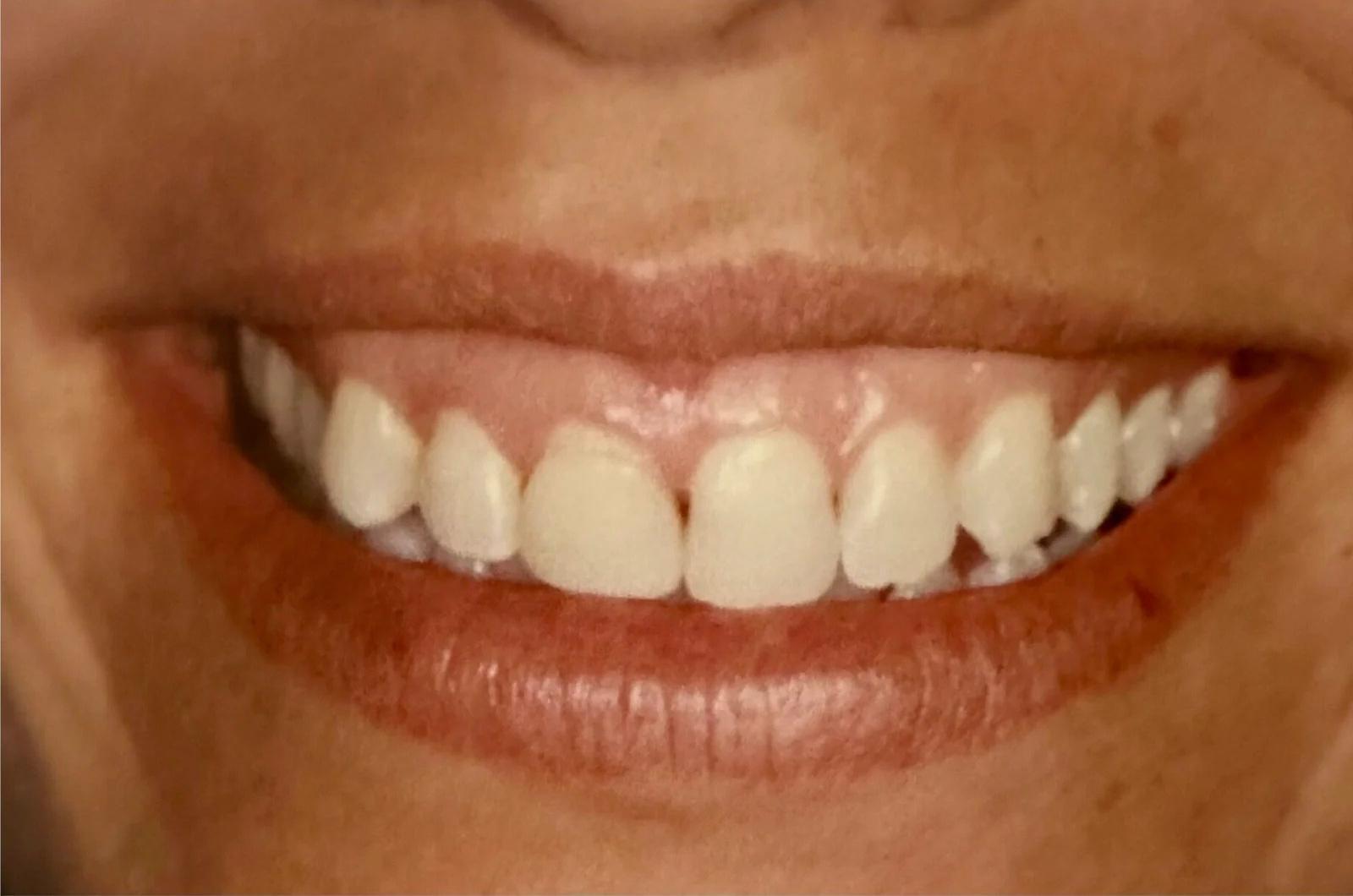 Second smile makeover before dental treatment